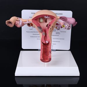 Autres fournitures scolaires de bureau de haute qualité Utérus féminin humain Maladie de l'ovaire Dissection Modèle de pathologie Biologie Aides pédagogiques Anatomie Lésion Dropship 230703