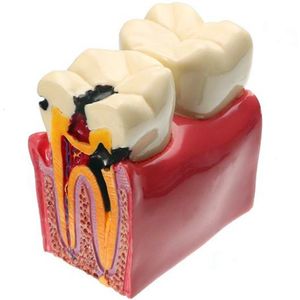 Autres matériaux d'hygiène buccale 1 pc Modèle de dents de laboratoire Modèles d'étude de comparaison de caries 6 fois pour l'étude et la recherche de dentiste 230915