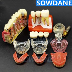 Otro Higiene Bucal Implante Dental Demostración Modelo Dientes Estudio Enseñar Modelo Análisis de Enfermedades con Restauración Corona Puente Maxilar Mandibular 230524
