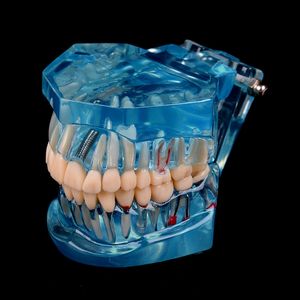 Otro modelo de dientes de enfermedad de implante dental de higiene bucal con puente de restauración Dentista dental para ciencia Estudio de enseñanza de enfermedades dentales 230720