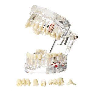 Otro Higiene bucal Modelo dental Dientes Implante Restauración Puente Enseñanza Estudio Ciencia Enfermedad Dentista Odontología Productos Regalo dental 230609