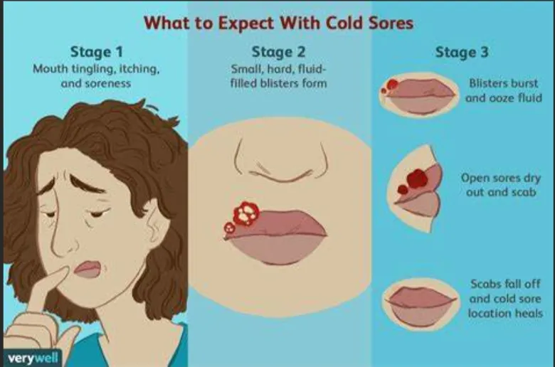 Best Cold Sore Ointment Say Goodbye to Painful Sores Quickly!