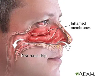 What is the Best Way to Stop Post Nasal Drip Immediately?