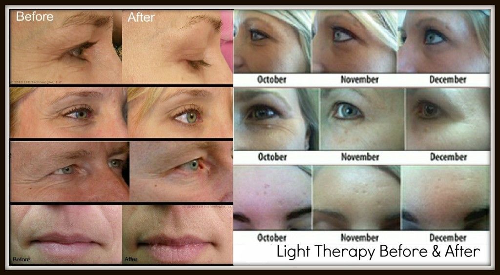 Green Led Light Therapy For Hyperpigmentation Shelly Lighting
