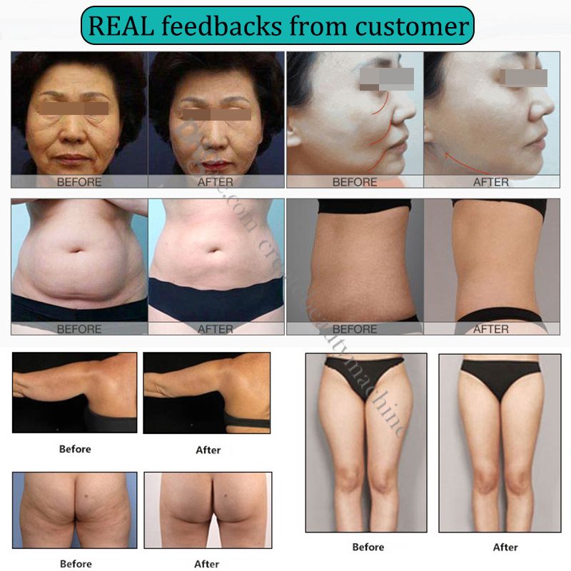 Hifu celulitis antes y despues