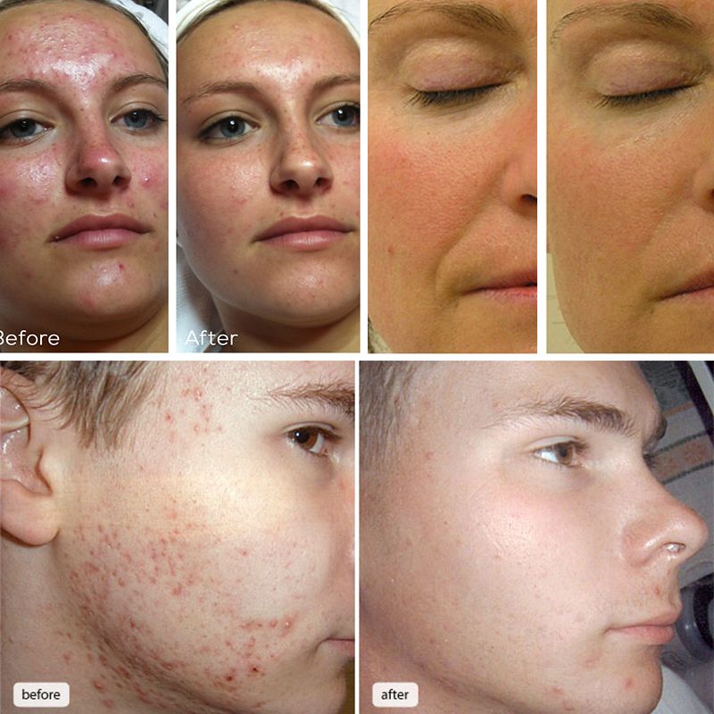 2020 Hot Sale Factory Price Spa Water Oxygen Facial Machine For Skin