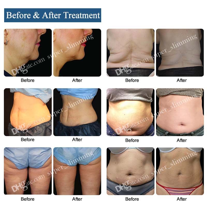 Venda Por Atacado De Brand Atacado Preco Cavitacao Lipoaspiracao Maquina De Emagrecimento Radiofrequencia Pele Apertada Lipo Laser Gordura Congelar O Equipamento De Perda De Peso Modernos E De Baixo Preco Dhgate Com Venda Por Atacado De Brand Atacado Preco Cavitacao Lipoaspiracao Maquina De Emagrecimento Radiofrequencia Pele Apertada Lipo Laser Gordura Congelar O Equipamento De Perda De Peso Modernos E De Baixo Preco Dhgate Com