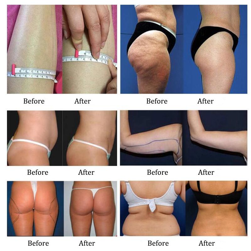NEW Technology Ultrasonic Cavitation Machine RF Cavitation Weight Loss Ultrasonic Fat Removal Slimming Machine Lipo Laser Fat Beauty Equipme Machine Ultrasonic Products For Slimming From Perfectlaserslimming, $772.08| DHgate.Com