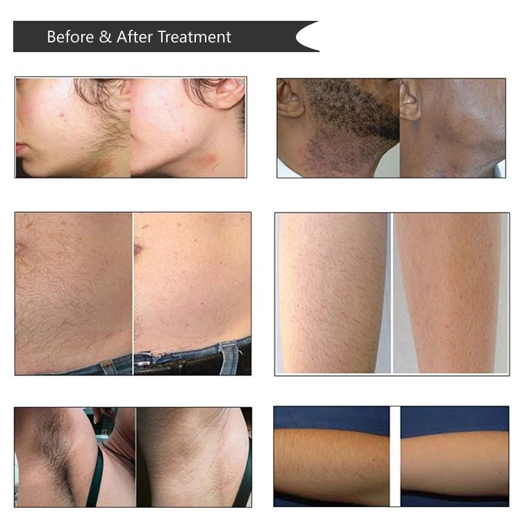 10 Million Pulses Permanent Hair Removal 808nm Diode Laser Hair