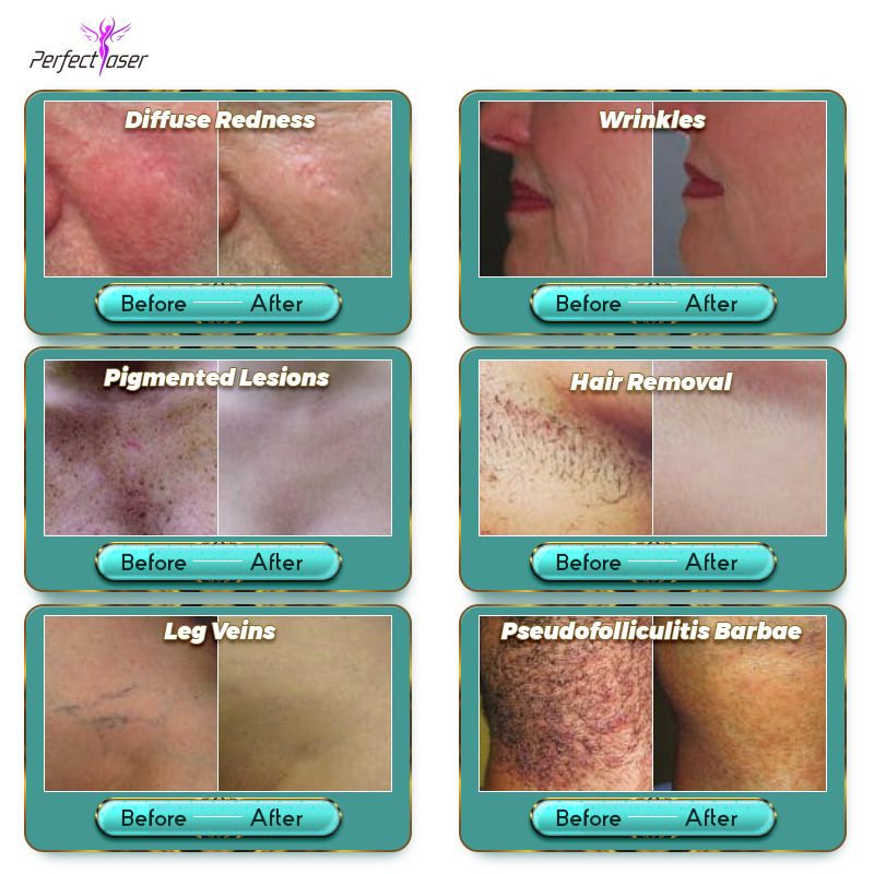 Fast safe q switch nd yag 1064 nm laser hair removal skin rejuvenation pigmentation at home Fast safe q switch nd yag 1064 nm laser hair removal skin rejuvenation pigmentation at home