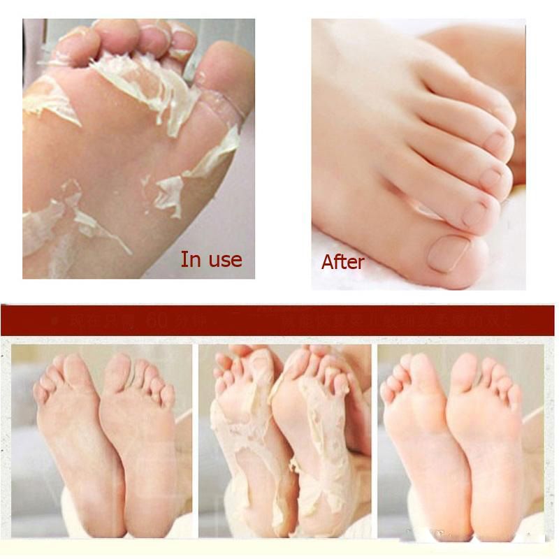 vinegar to remove dead skin on feet