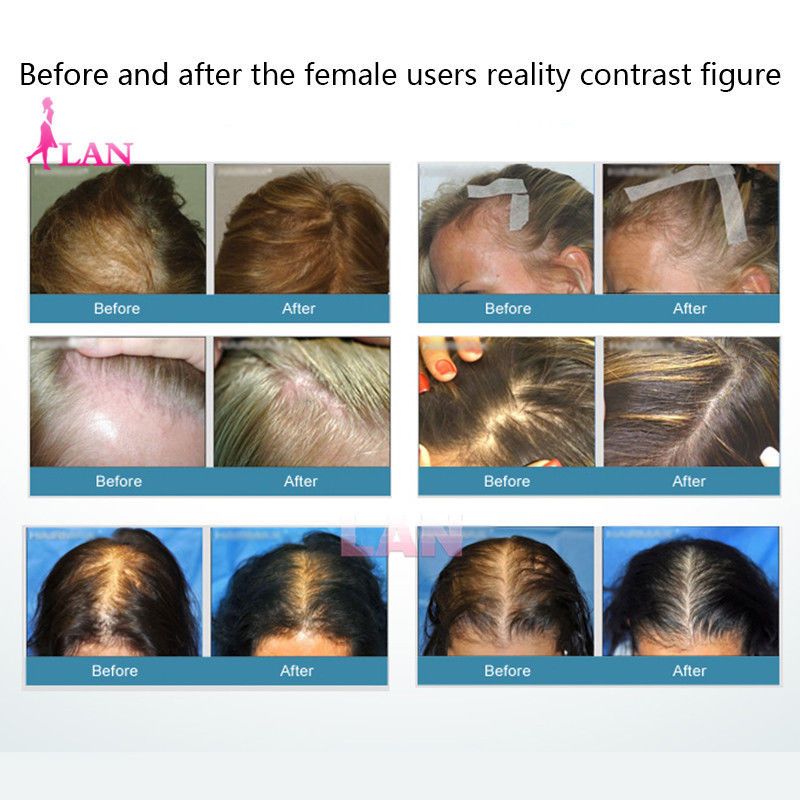 Laser Comb Hair Growth Loss Regrowth Treatment Electric Infrared