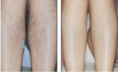 Лазерная эпиляция голени. Интервал лазерной эпиляции. Интервал лазерной эпиляции. Межъягодичная складка лазерная эпиляция. Лазерная эпиляция элос.