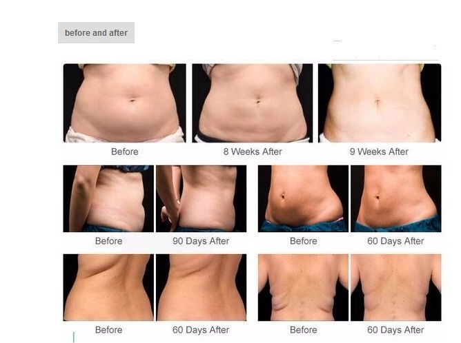 Grosshandel 2018 Neueste Drei Cryo Kopfe Cryolipolysis Rf