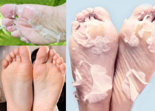 peau seche pied
