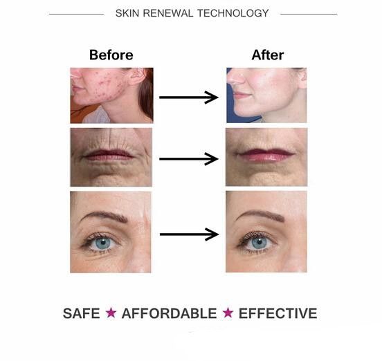 derma roller dark circles before and after