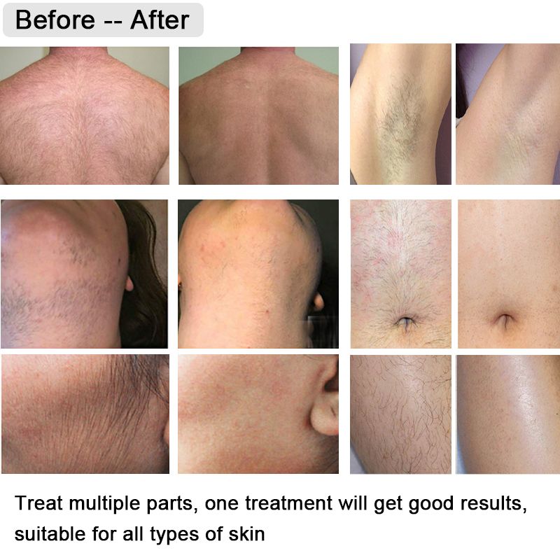 is laser hair removal permanent