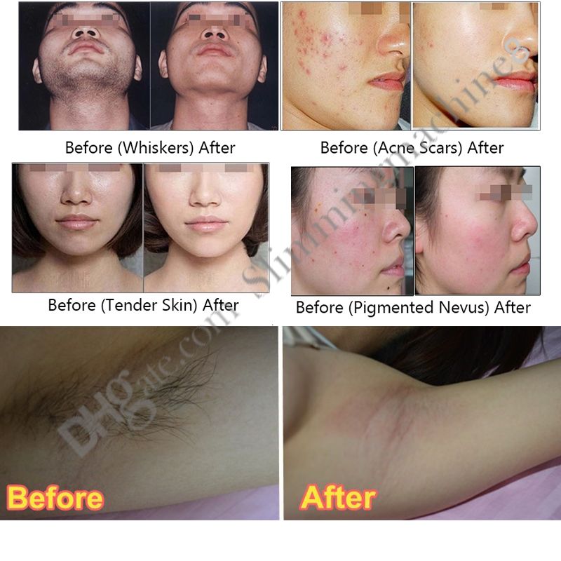 permanent hair removal women's facial hair