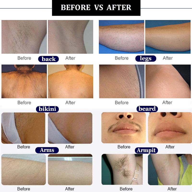 808nm Diode Laser Natural Permanent Unwanted Leg Facial Hair