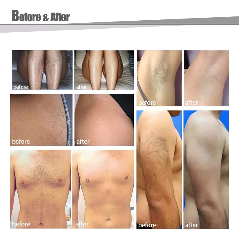 male permanent hair removal