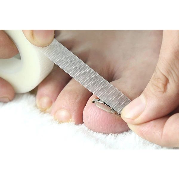 1 Réglage du correcteur de l'ongle incorporé Fixer orthotique Nail Fixer de correction de l'ongle Traitement des pieds outils de soins de la file