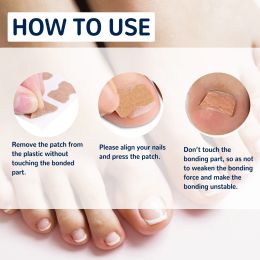 100 stcs ingegroeide teennagelcorrector sticker voetverzorging pedicure voet orthodontische teen duim nagelverzorging patches