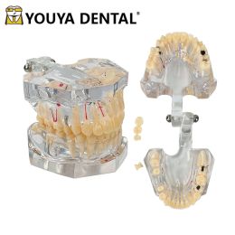 2,5 fois Modèle pathologique avec des caries dentaires pour la formation de la pratique des étudiants dentiste pour étudier le modèle d'enseignement médical oral