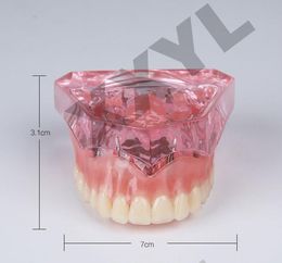 Dental dentist implant restoration esqueleto anatomia teeth Disease human anatomy skeleton anatomical model for teeth whitening
