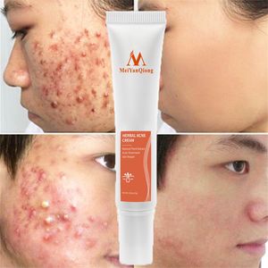 Acne Scar Removal Cream Gel Herbal Anti-Acne Treatment Fade Acne Spots Whitening Moisturizing Oil Control Shrink Pores Skin Care