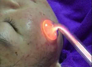 Nuova acne ad alta frequenza che rimuove l'elettrodo di bellezza Bacchetta per la cura della pelle Spa antinfiammatoria Macchina per il viso di bellezza