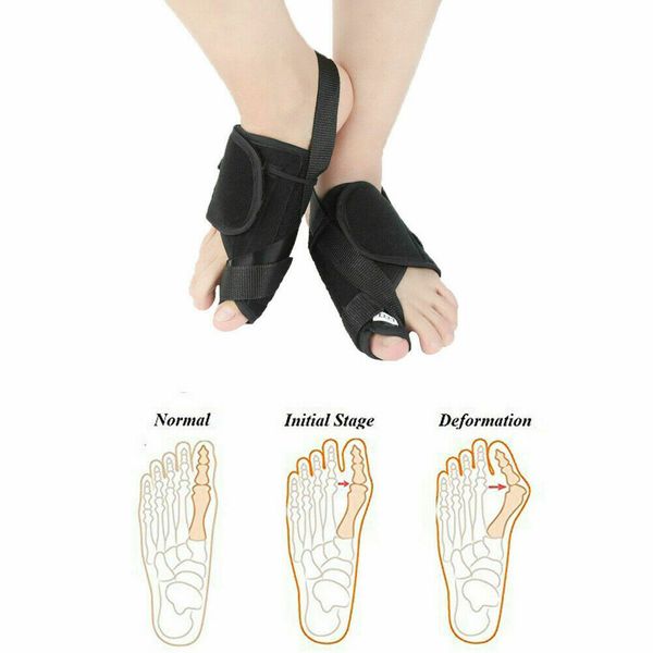 

2019 foot care bunion splint big toe straightener corrector foot pain relief hallux valgus orthopedic supplies pedicure