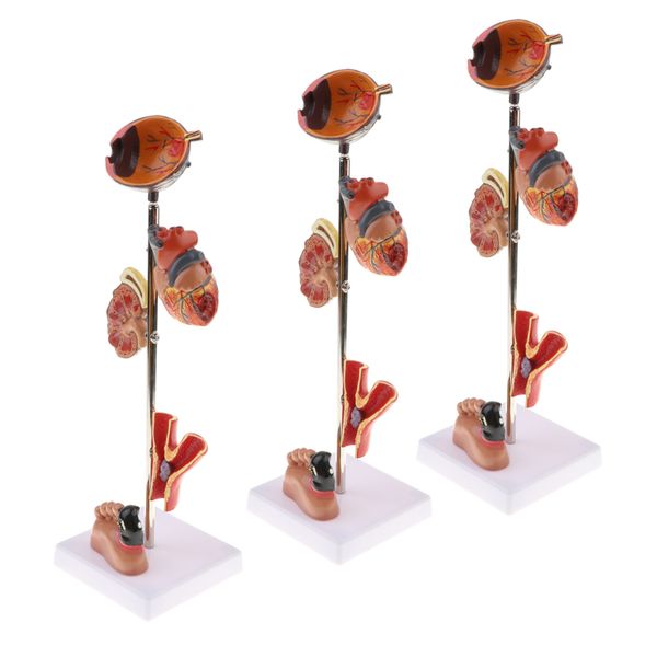 

lots 3 effect of diabetes 5 parts models for lab demonstration study aids