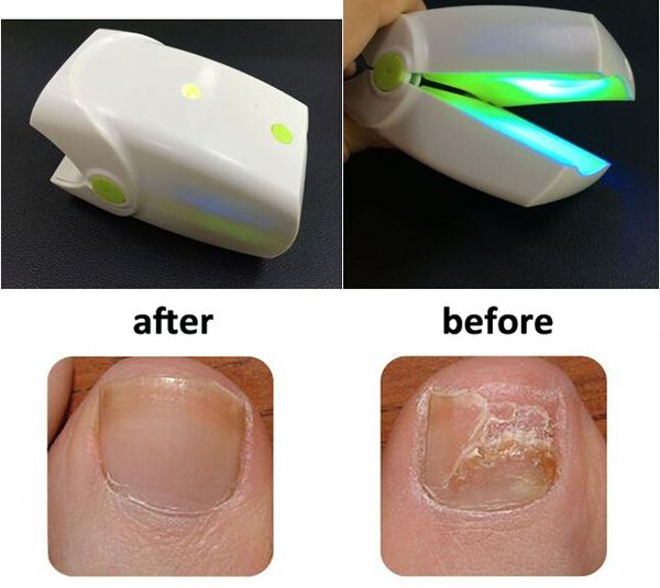 

nail fungus laser treatment instrument anti fungal laser device low level lllt toenails home use no pain
