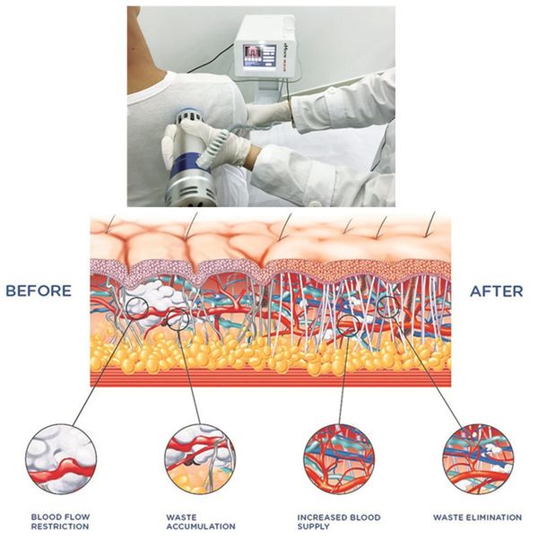 

high effective selling physiotherapy extracorporeal ed shockwave therapy equipment/clinic and home use ed shockwave therapy machine