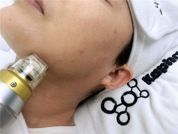 

fractional rf microneedle machine for stretch marks removal micro needle device fractional radio frequency therapy machine for skin care