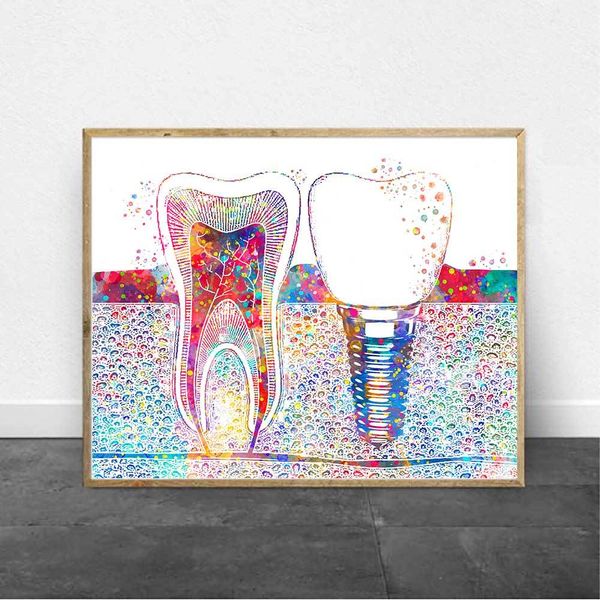 

dental art picture tooth implant canvas print dentist wall art painting medicine hygienist poster tooth watercolor clinic decor