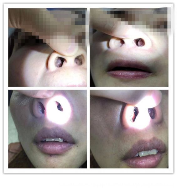 

ofh2a children's turbinate hypertrophy congestion unventilated anaphylactic artifact sneezing nasal sinus children's turbinate hyp