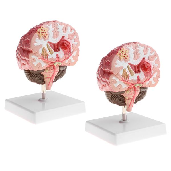 

2 pcs уменьшенная human brain diseased cortex diseased патологическая демонстрация модели лабораторное оборудование наука игрушки