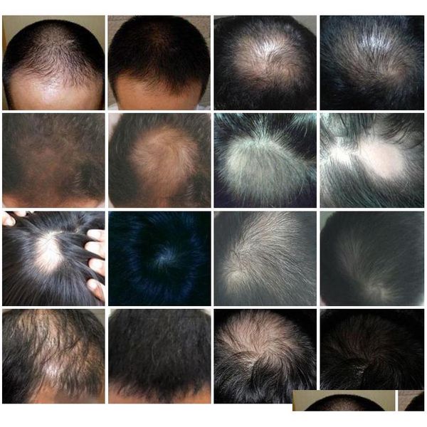 

low level laser therapy hair loss solution products with 64 medical diodes la qyldpr lipper