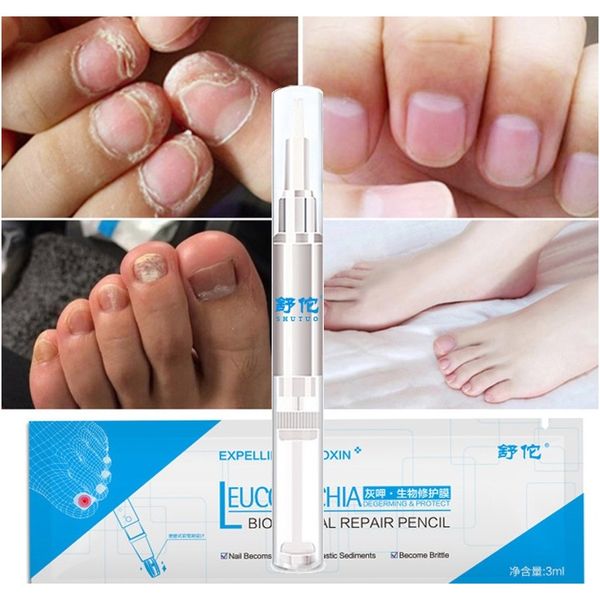 

nail repair liquid treatment nail fungus treatment pen fungal nail foot fungus remove gel 2020 wmtdxr
