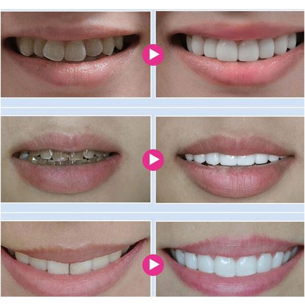 

5 шт. пероральные гигиенические зубы отбеливающие гель безопасный удалить пятна agent стоматологическая помощь красота зубы холодных легких