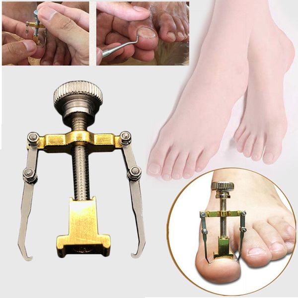 

ingrown toenails pedicure foot nail care tools file for feet ortc acronyx ingrowing nail onyxis bunion corrector massage