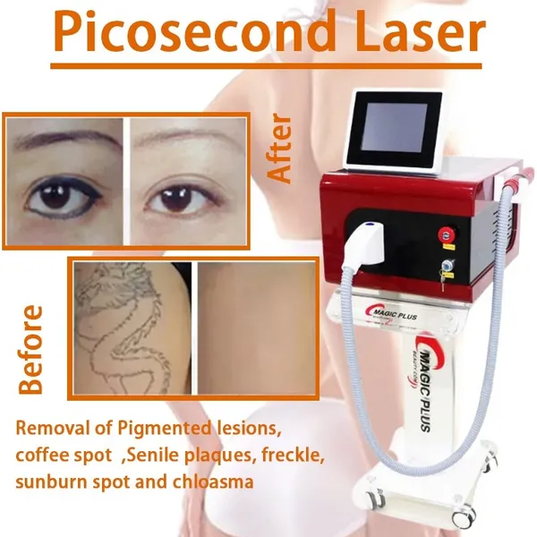 Máquina a laser Micro Plexr Plasma elevador de plasma Freckles Skin Tag Skin Spot Removedor de ponto escuro para tatuagem de tatuagem de face Terapia com picossegundos CX200825