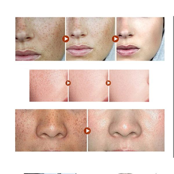 

9 level laser freckle removal pen mole tattoo removal machine lcd laser plasma pen dark spot granulation remover for face beauty perfections