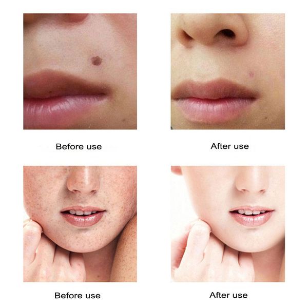 

beauty instrument led lighting laser tattoo mole removal machine face care skin tag removal freckle wart dark spot remover perfections