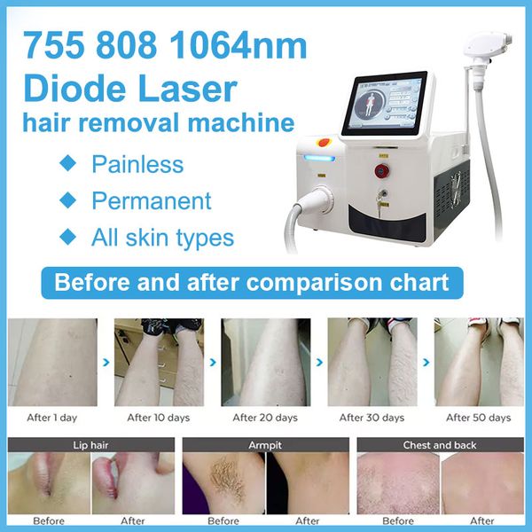 Máquina de laser de diodo portátil 755nm 808nm 1064nm 3 comprimento de onda Remoção de cabelo Equipamento de salão