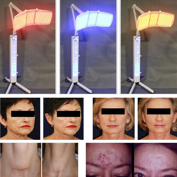 

Bio light led pdt lamp facial kin rejuvenation kin refre he acne wrinkle care
