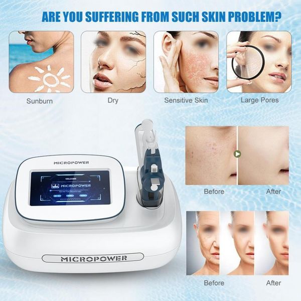 Microneedle Portable Fracionário RF Máquina Equipamento No-Agulha Mesmoterapia Meso Arma Rejuvenescimento Rujuvenescência Remoção Remoção Face Levantando Beleza