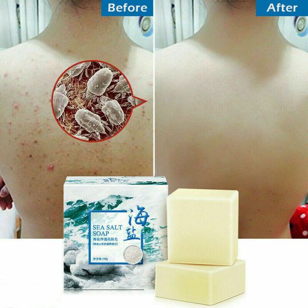 

sea salt soap milk face wash soap skin pimple pores acne acne treatment goat