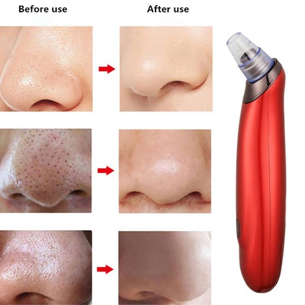 

face clean blackhead remover skin care pore vacuum acne pimple removal vacuum suction tool facial